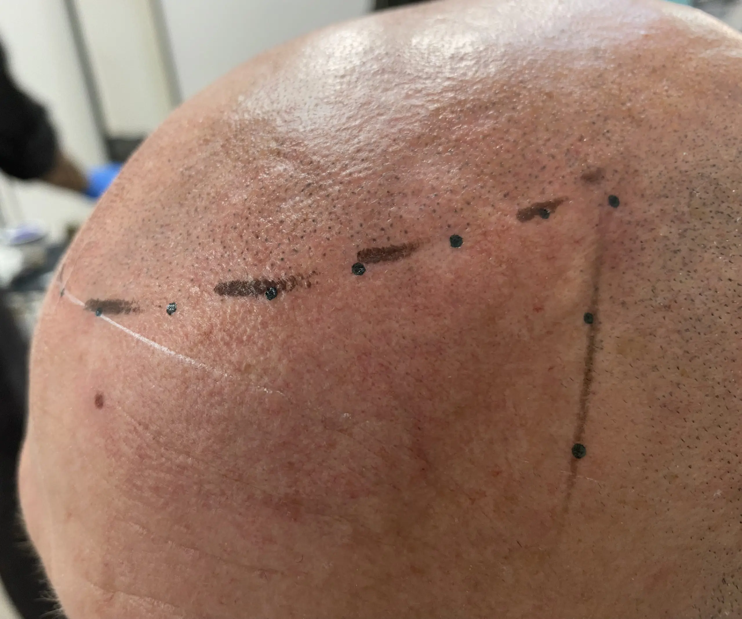 Micropigmentación Capilar con Efecto Rapado